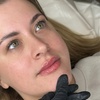 Image 2: Stunning Lips Awaits with 0.5 or 1 ml of Russian Lips Dermal Filler