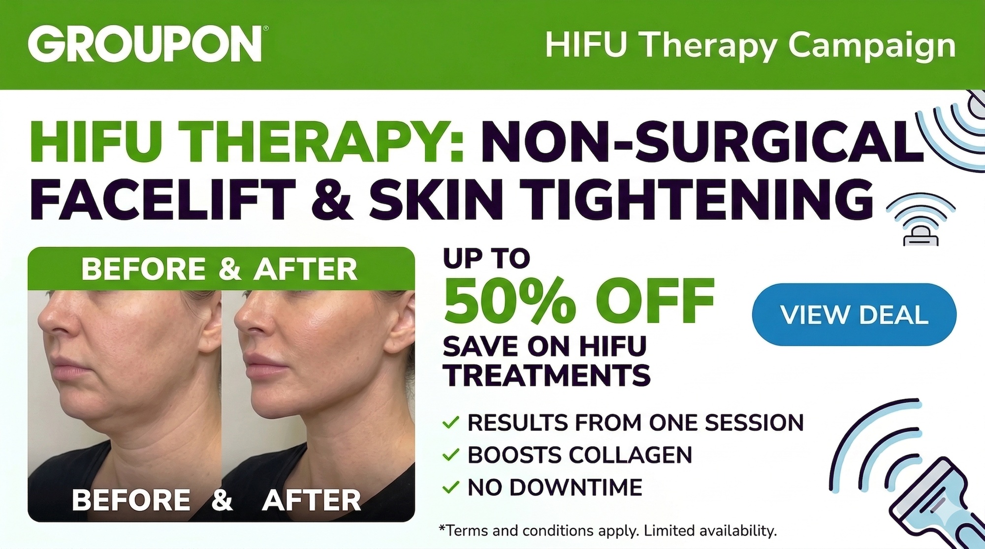 High-Intensity Focused Ultrasound Non-Surgical Face Lift