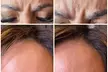 Up to 54% Off on Injection-Other-Dysport, Xeomin at Ameze Skin Elements - Second Medium