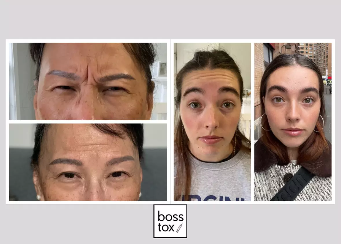 Refresh Your Look with 10, 20, or 30 Units of Xeomin/Jeuveau