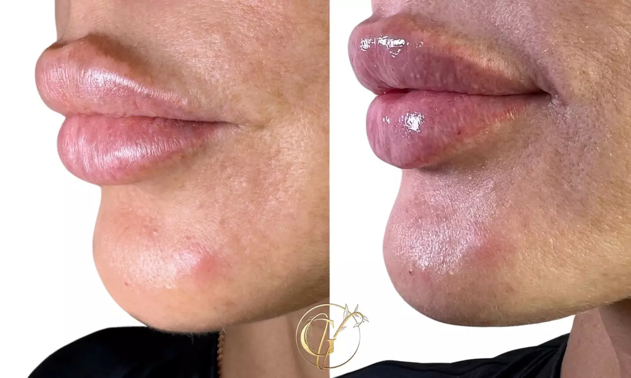 It's Time To Bring Your Youth Back w/ 20-60 Units of Botox