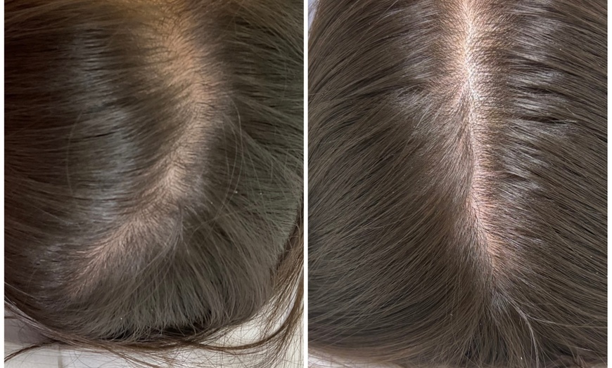 Image 2: Hair Restore Treatment PRP + Microneedling, Exosomes & Celluma Light