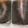 Image 2: Hair Restore Treatment PRP + Microneedling, Exosomes & Celluma Light