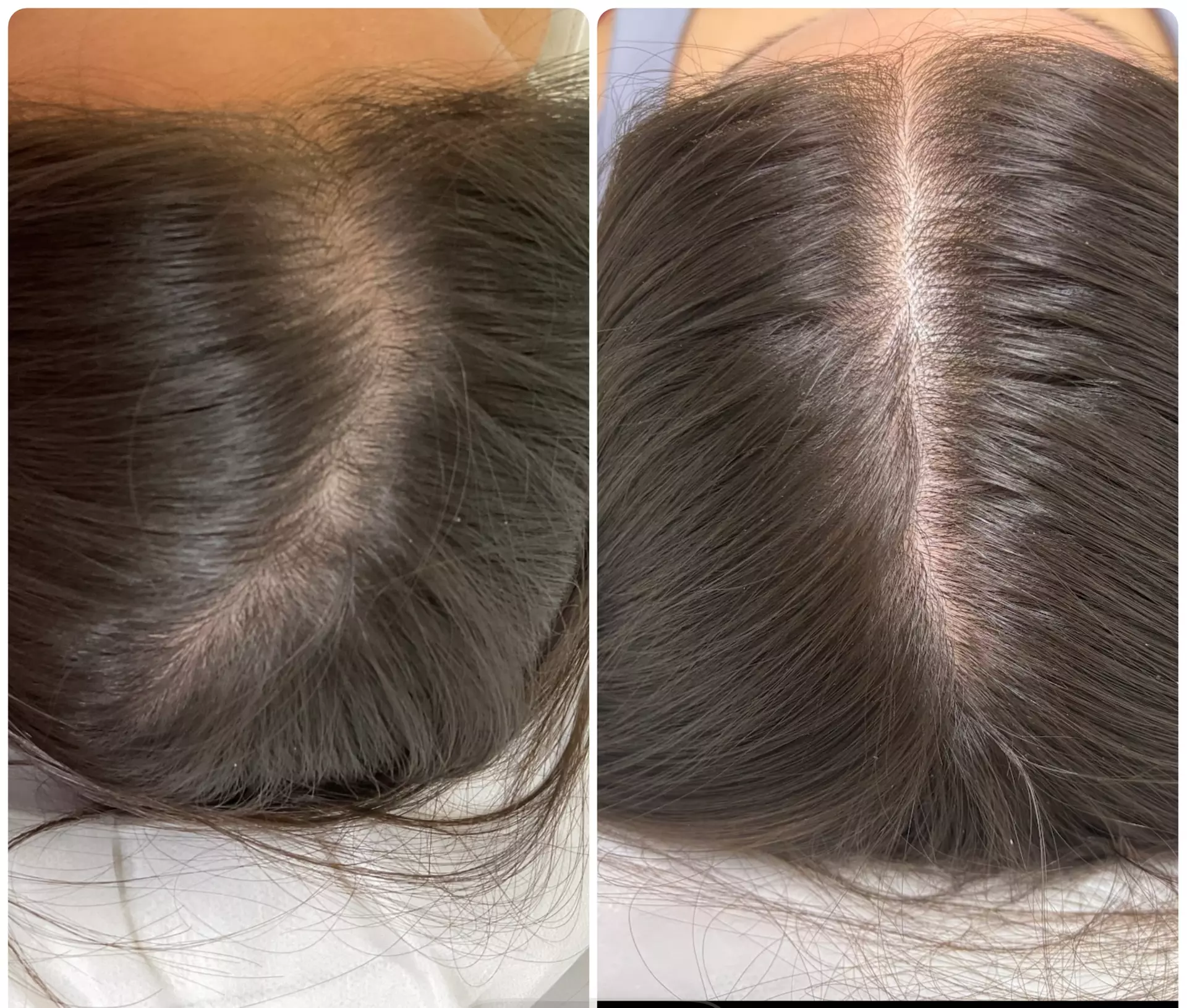 Hair Restore Treatment PRP + Microneedling, Exosomes & Celluma Light