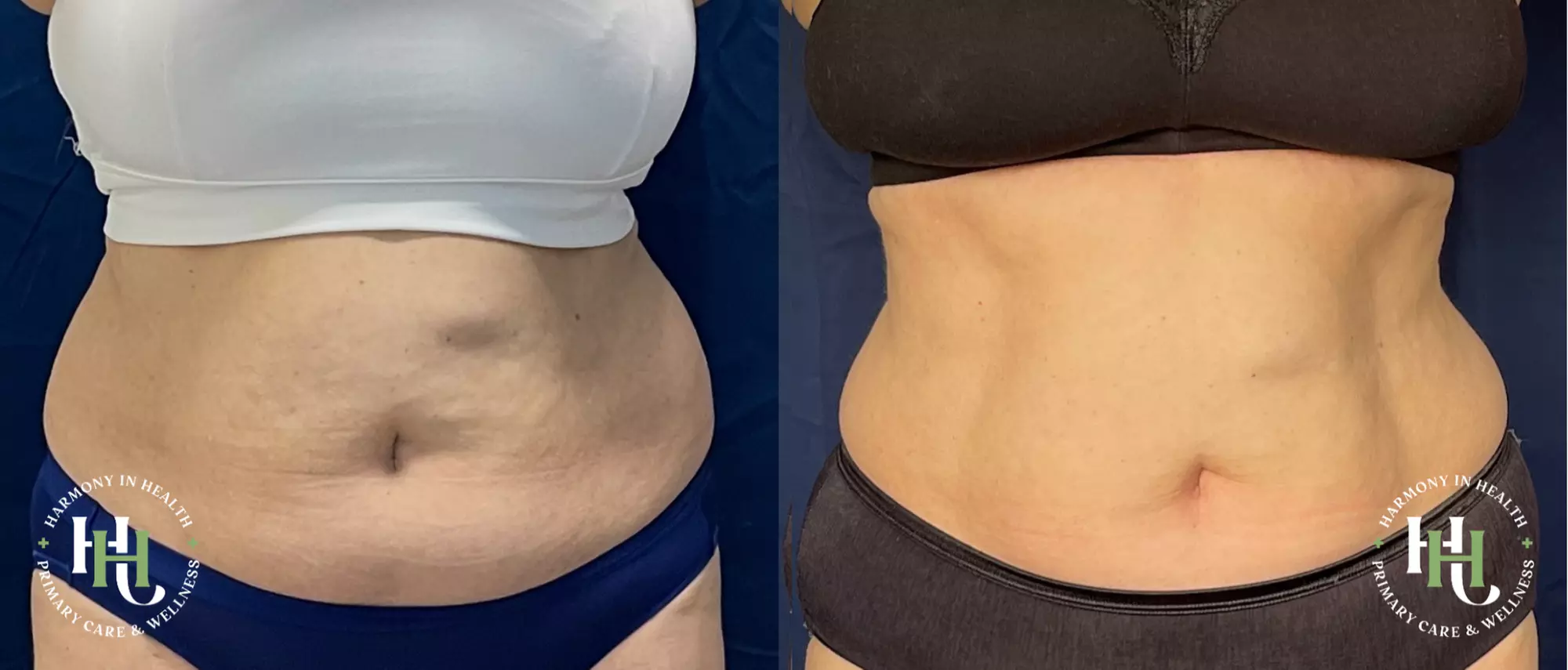 Get EMS Sculpt Abs/Buttocks/Thighs in Just 30 Minutes (Up to 74% Off)