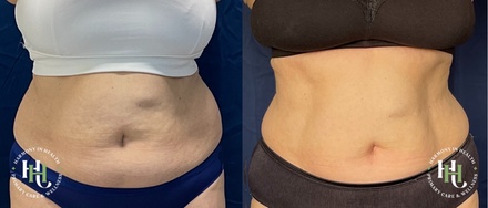 One 30 Min Tricep or Bicep Body Contouring Treatment - Harmony In Health