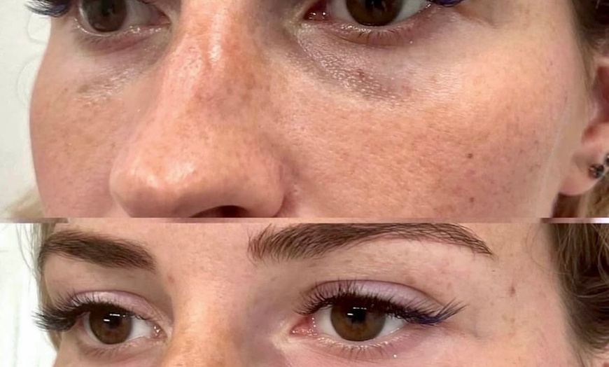 Image 1: Up to 64% Off on Dark Circle / Under Eye Treatment at aesthetic zone