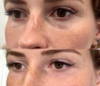 One session of Lumi eyes treatment; must be 18 or older - Aesthetic Zone
