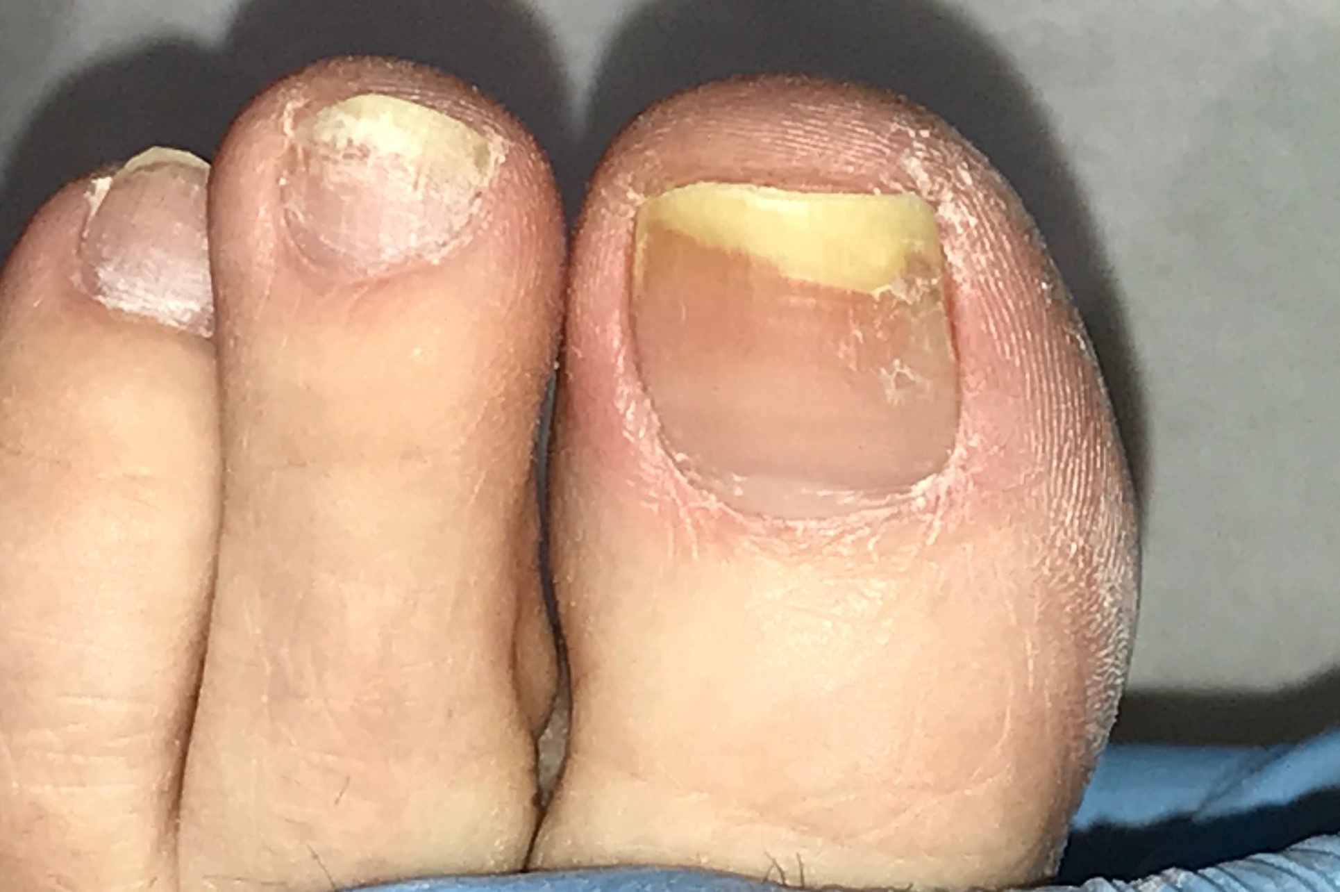 Get Rid of Toe Fungus with 3 Laser Treatments for Feet or Toe