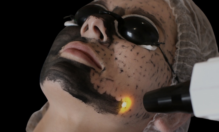 Image 2: Laser Hair Removal, Tattoo Removal, Carbon Peel, Acne Treatments