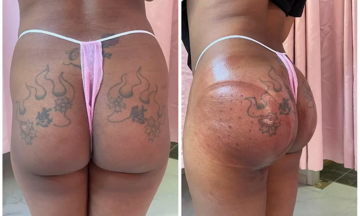 Lift and tone with nonsurgical butt cupping sessions