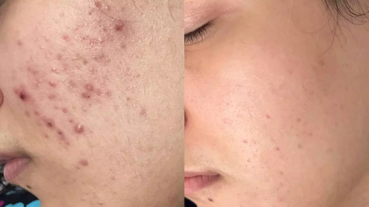 Luxury 1,2 or 3 60-Minute Chemical Peel or Signature Facials