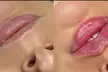 Up to 30% Off on Injection - Dermal Filler at No Pain All Gain Spa - Second Medium