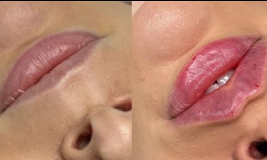 Image 3: Up to 30% Off on Injection - Dermal Filler at No Pain All Gain Spa
