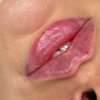 Image 3: Up to 30% Off on Injection - Dermal Filler at No Pain All Gain Spa