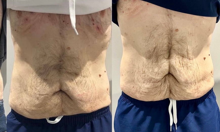 Image 4: Single or Two Area Sculpting, Private Sauna, Body Sculpt, & More