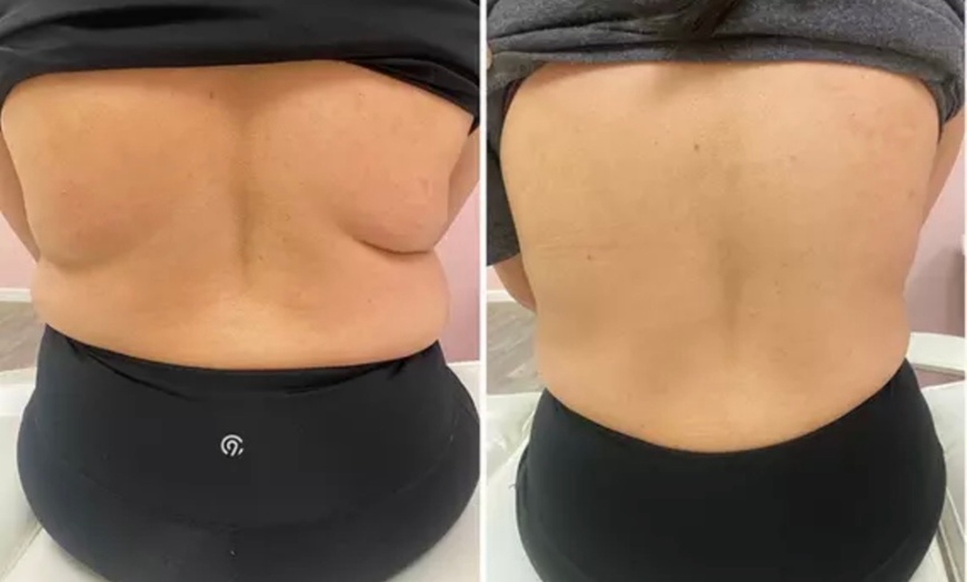Image 3: Up to 62% Off on Fat Reduction - Non-Branded at Beauty By Bear