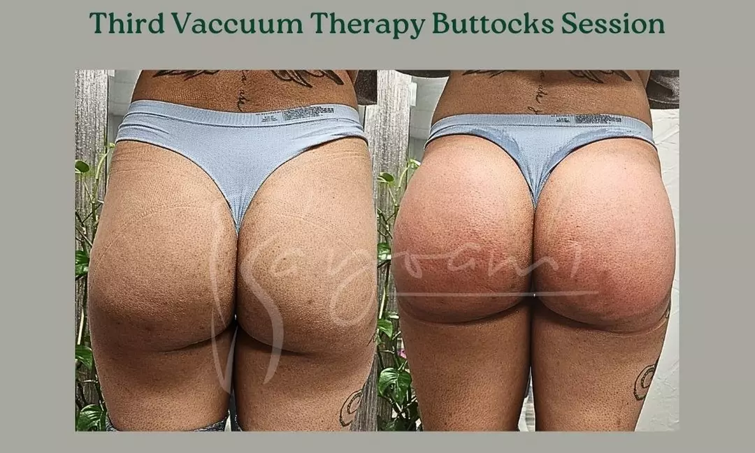 Vacuum Therapy Buttocks & Body Enhancement or CryoStatic Slimming