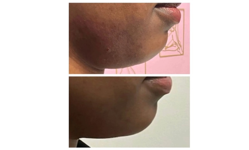 Image 2: Get One Session on Small Area: Mesotherapy Fat Melting (PCDC)