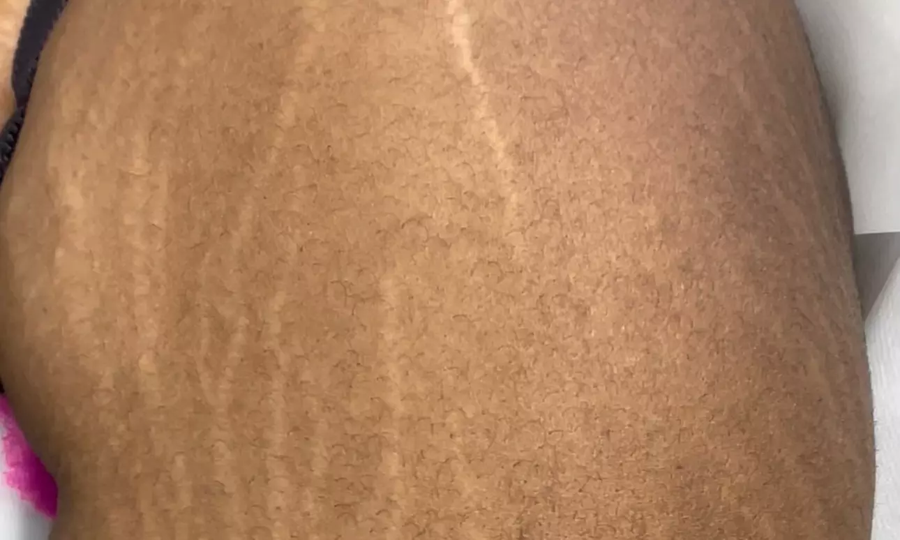 Up to 60% Off on Micro-Needling at Imperfections