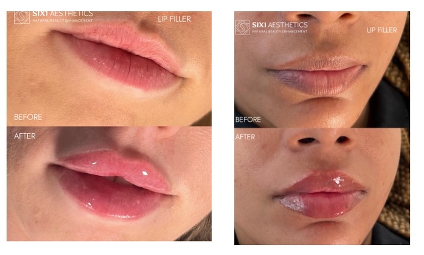 Image 5: Revitalize with 1ml, 2ml, or 3ml Dermal Fillers for Cheek, Jaw or Chin