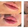 Image 5: Revitalize with 1ml, 2ml, or 3ml Dermal Fillers for Cheek, Jaw or Chin