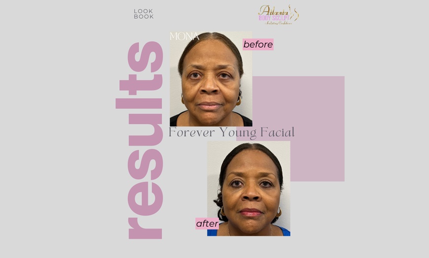 Image 4: Therma-Lift Facelifts for Youthful Skin with No Downtime