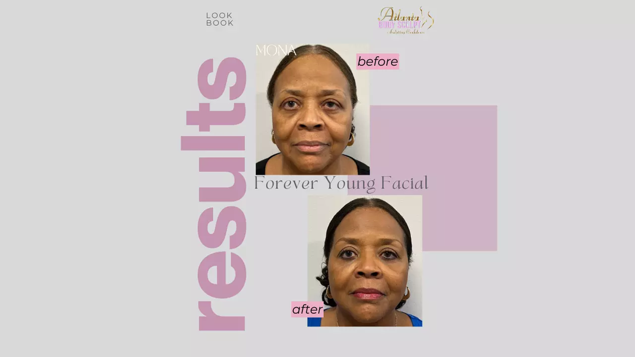 Therma-Lift Facelifts for Youthful Skin with No Downtime