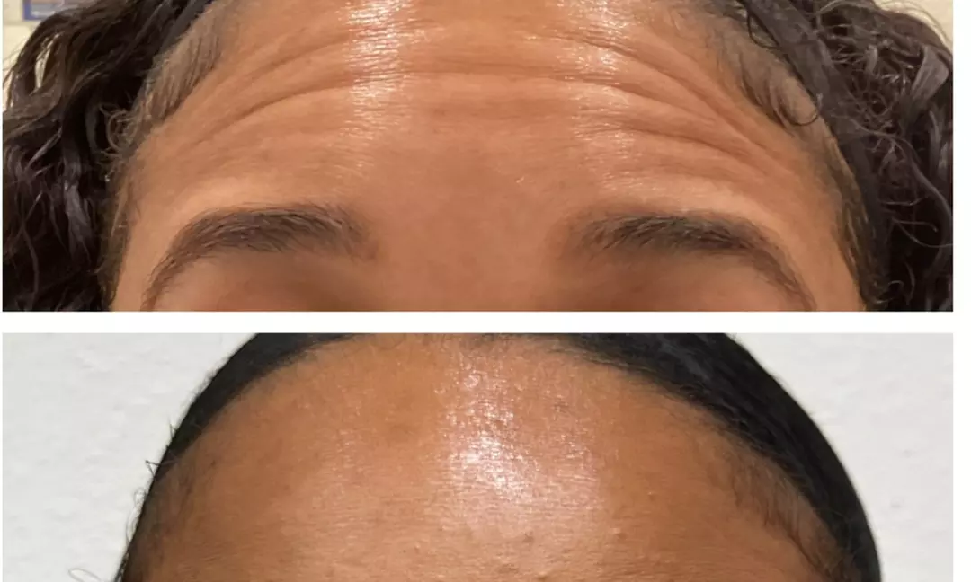 Smooth Your Skin with 20, 40 or 60 Units of Xeomin Injections