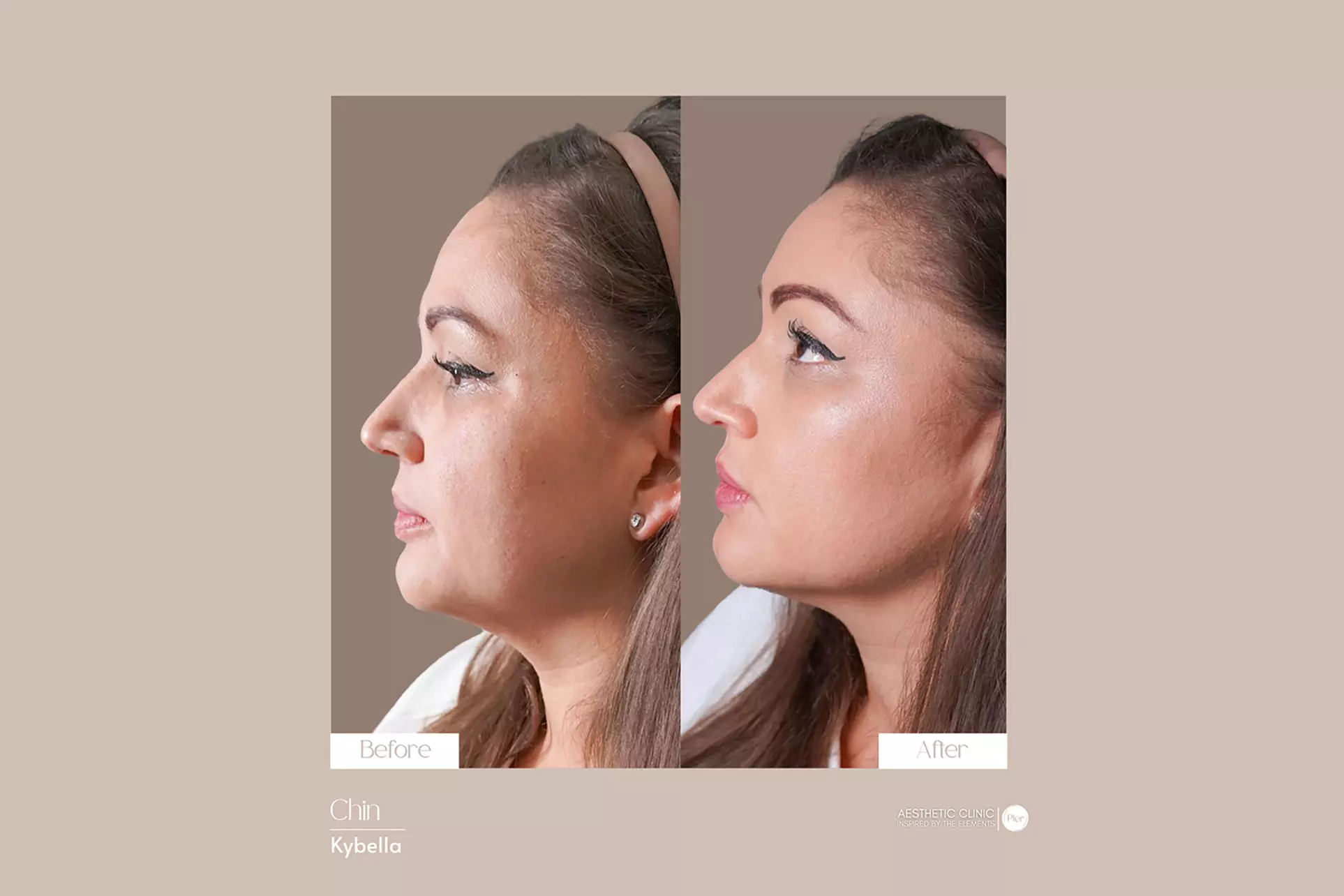Smooth, Youthful Skin Awaits: 20 or 40 Units of Botox at Pler Miami