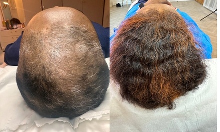 One Session of PRP Hair Restoration or Facial Treatment - Skin Treat Aesthetics