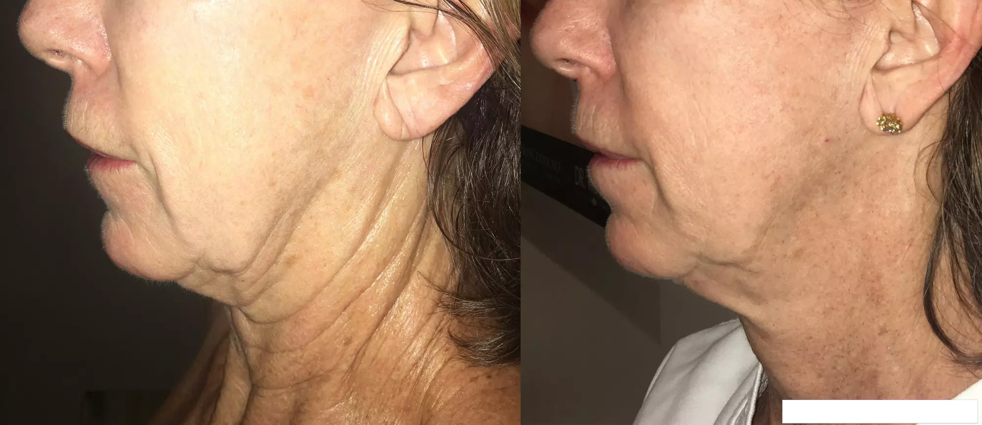 Get One or Two Morpheus8 Sessions w/ Optional 20 or 40 Units of Xeomin