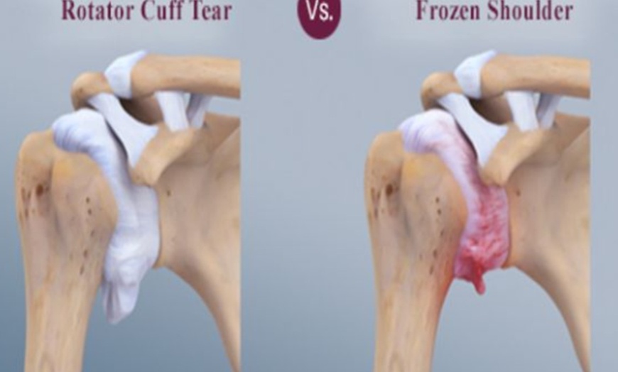 Image 3: Shoulder Pain & Sciatica Relief with Shockwave Therapy