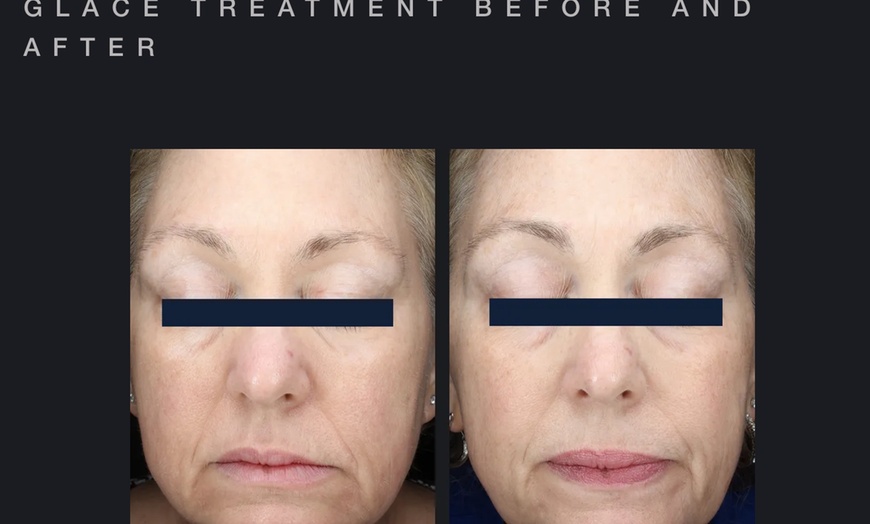 Image 6: Glow with One or Three Glacē™ Skin Treatments