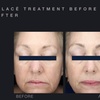 Image 6: Glow with One or Three Glacē™ Skin Treatments