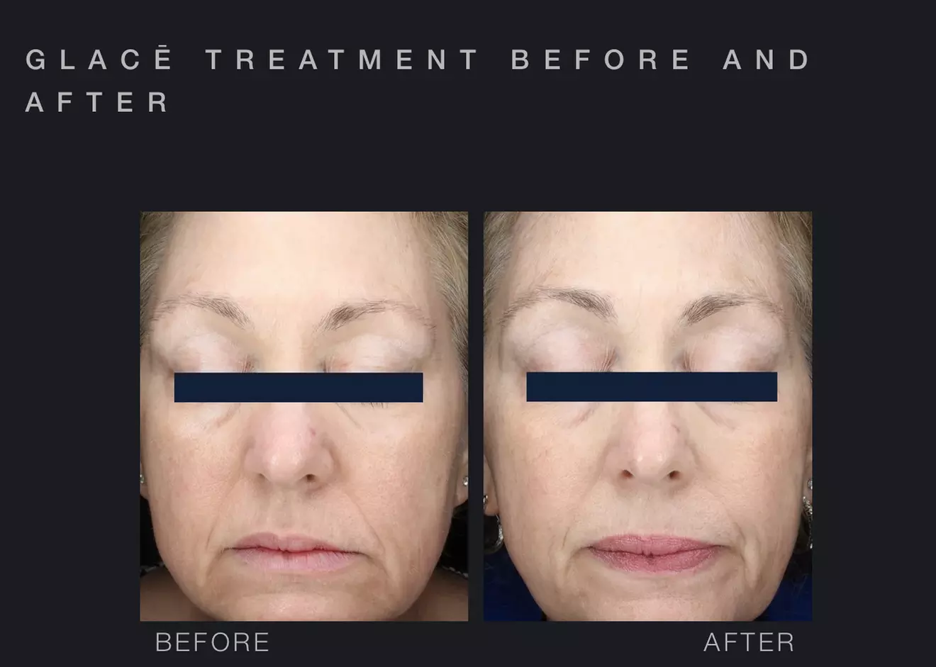 Glow with One or Three Glacē™ Skin Treatments