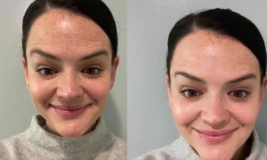 Image 3: Dysport & Restylane: Smooth Wrinkles and Restore Volume