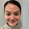 Image 3: Dysport & Restylane: Smooth Wrinkles and Restore Volume