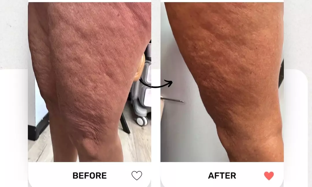 Up to 58% Off Radio Frequency Skin Tightening at The Body Lux