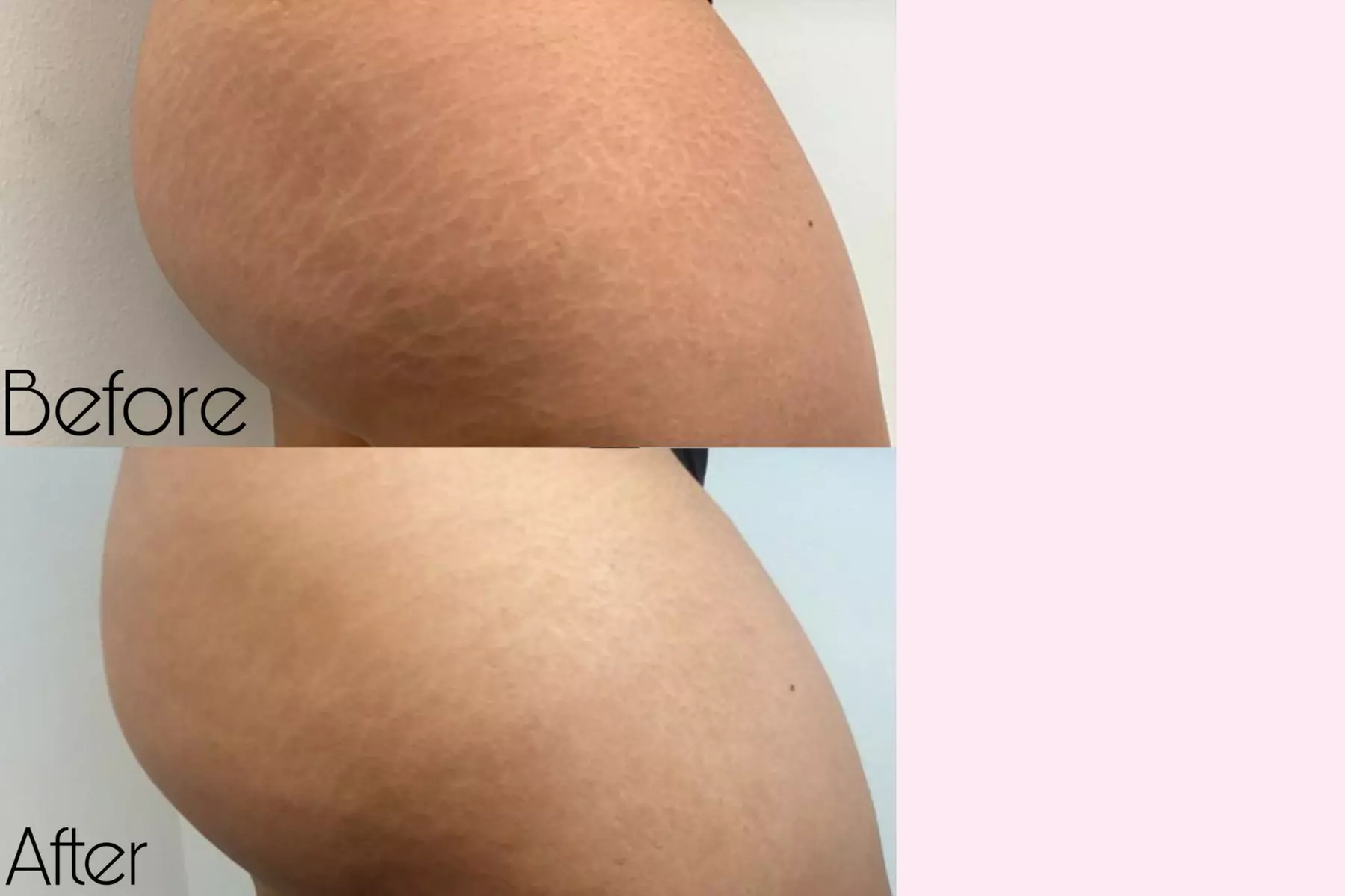 Inkless Scar or Stretch Mark Camouflage w/ Red Light Therapy, and More