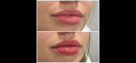 0.5 ml Lip Filler - Dermaesthetics