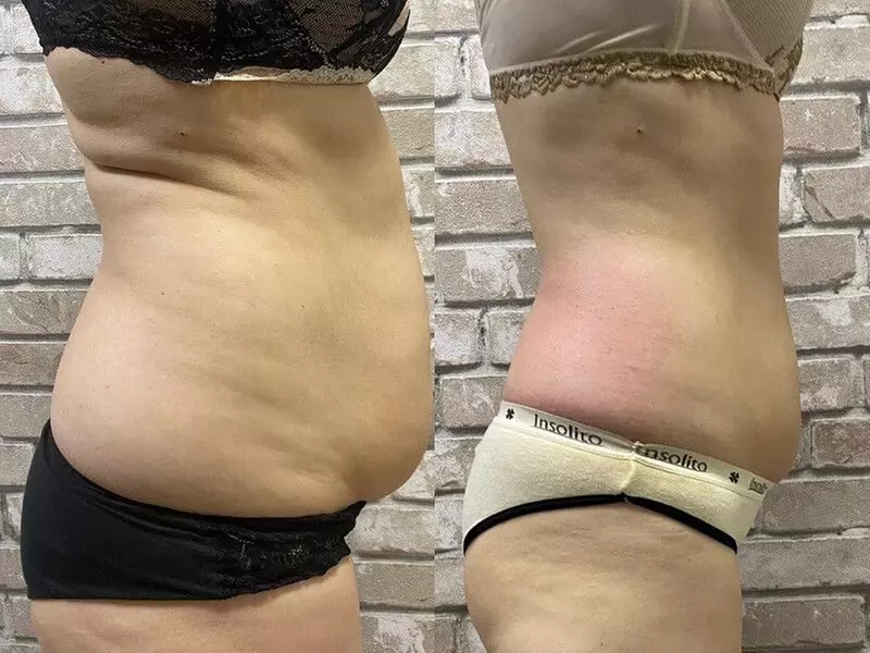 Transform with Next-Generation 10D & Advanced Laser Lipo Treatments