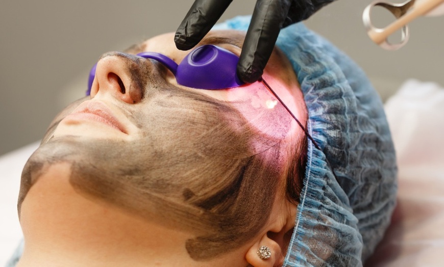 Image 2: Get Glowing Skin with 1 or 6 Sessions of Carbon Laser Peel Facial at Agatha K Micropigmentation (Up to 48% Off)