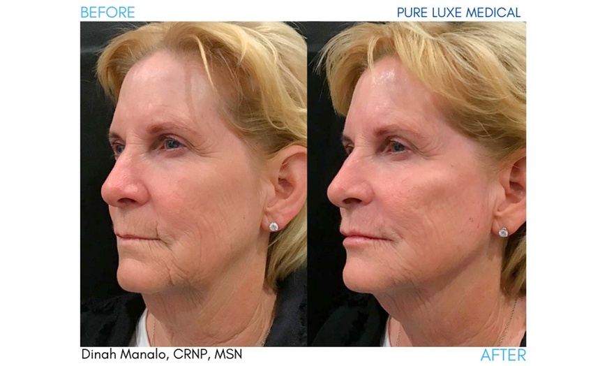 Image 10: 20 Units of Botox for Frown Line or Crow's Feet or Juvéderm & More
