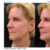 Image 10: 20 Units of Botox for Frown Line or Crow's Feet or Juvéderm & More