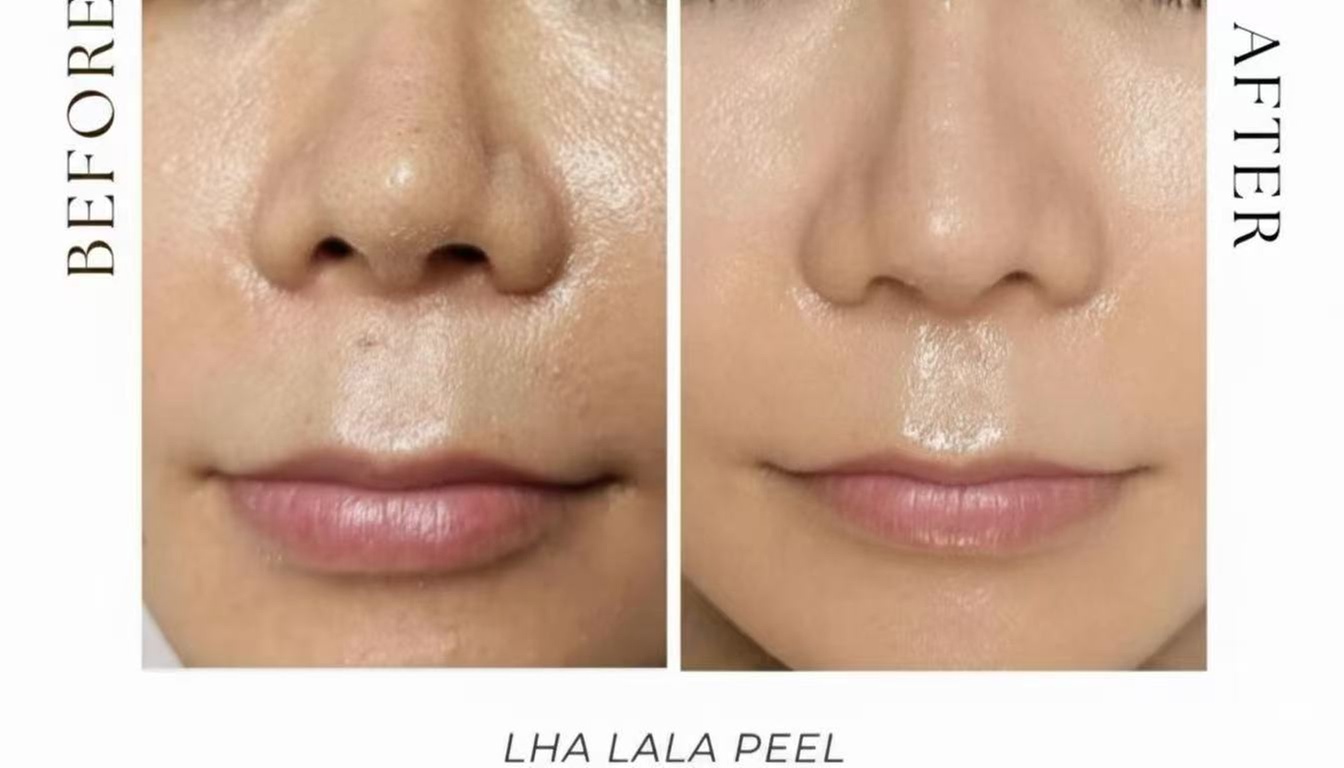 Refresh w/ a Korean LHA PEEL for Face or with Neck