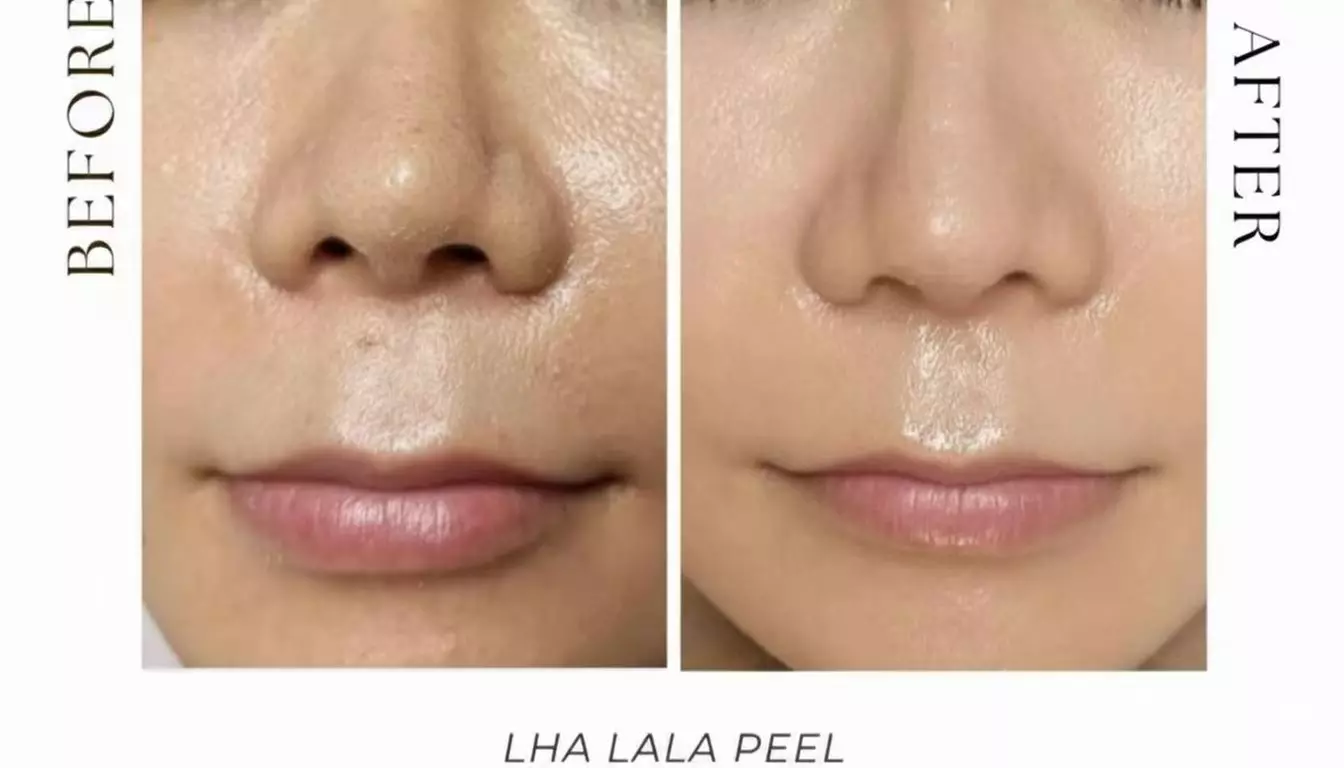 Refresh w/ a Korean LHA PEEL for Face or with Neck