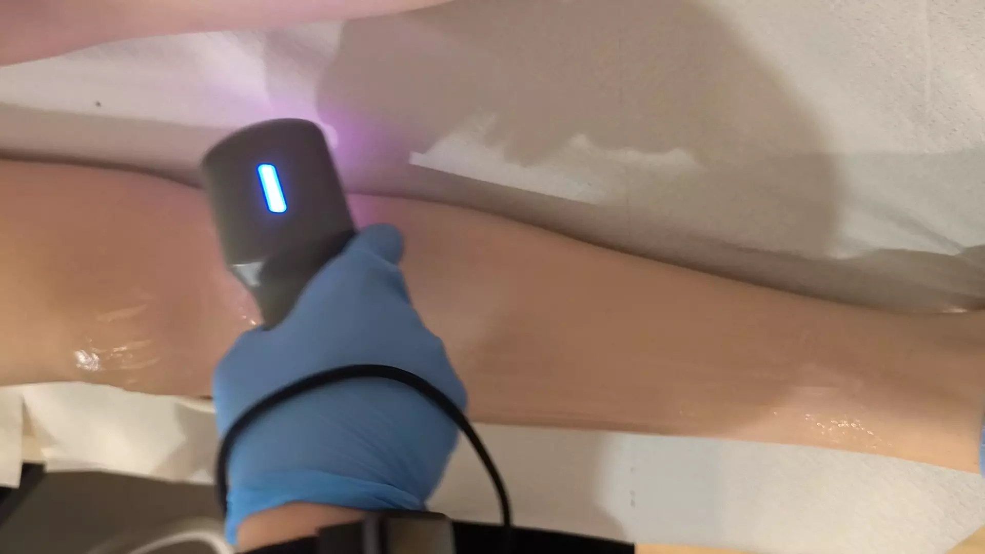 Depilacja laserowa wybranych obszarów