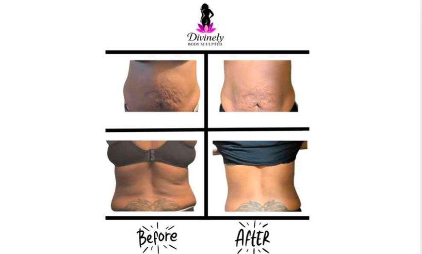 Image 2: 3-Session Slim & Sculpt – 60 Min Body Contouring Series