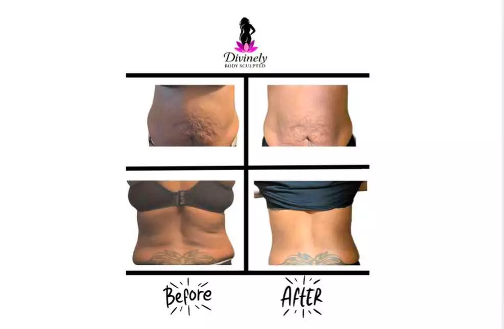 3-Session Slim & Sculpt – 60 Min Body Contouring Series